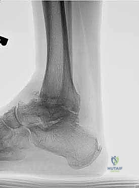 التخطيط الجراحي المسبق باستخدام الأشعة المقطعية
