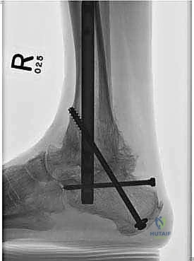 المسمار النخاعي المستخدم في تثبيت القدم الخلفية