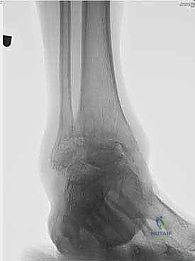 الأشعة السينية قبل وبعد عملية تثبيت الكاحل