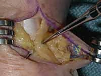 Thumb Carpometacarpal Arthrodesis: An Intraoperative Masterclass for Basal Joint Arthritis