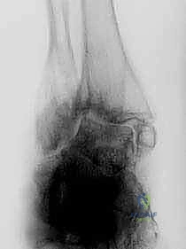 أعراض آلام الكاحل المتقدمة وتشوه القدم