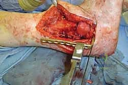 أسباب تآكل مفصل الكاحل المتقدم