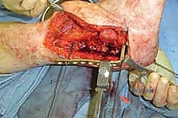 صورة توضيحية لـ دمج مفصل الكاحل والقدم الخلفية بتقنية صفيحة الشفرة الجانبية الحل الأمثل لآلام الكاحل المتقدمة