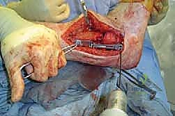 التشريح الدقيق لمفصل الكاحل والقدم الخلفية