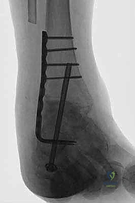 تركيب صفيحة الشفرة الجانبية في الكاحل