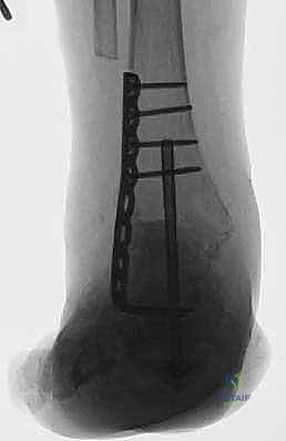 خطوات تحضير الأسطح المفصلية في الكاحل