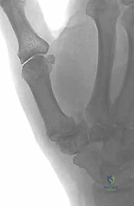 Illustration of base of the metacarpal - Dr. Mohammed Hutaif