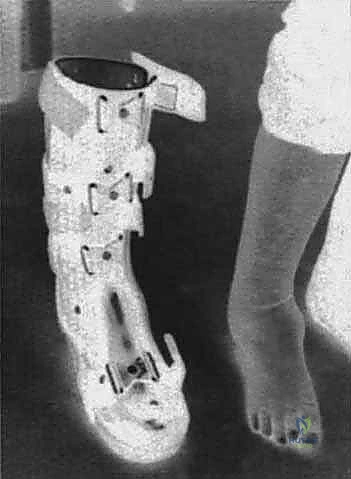 Tibiocalcaneal Arthrodesis Using Blade Plate Fixation