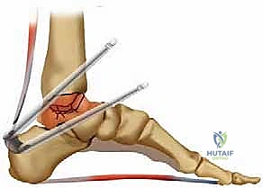 FIG 3 Nutcracker effect theorized to lead to talar fragmentation in Charcot neuroarthropathy