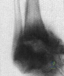 FIG 3 Nutcracker effect theorized to lead to talar fragmentation in Charcot neuroarthropathy