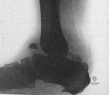 FIG 3 Nutcracker effect theorized to lead to talar fragmentation in Charcot neuroarthropathy