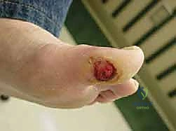 FIG 5 Calcified vessels commonly seen radiographically in diabetics