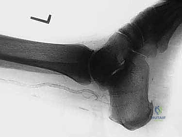 FIG 5 Calcified vessels commonly seen radiographically in diabetics