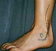 TECH FIG 3 Our routine allograft bone for tibiocalcaneal arthrodesis