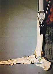 TECH FIG 3 Our routine allograft bone for tibiocalcaneal arthrodesis