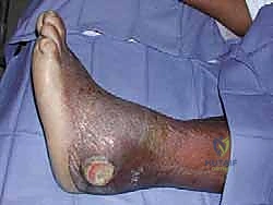 TECH FIG 3 Our routine allograft bone for tibiocalcaneal arthrodesis