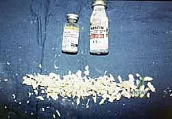 TECH FIG 3 Our routine allograft bone for tibiocalcaneal arthrodesis