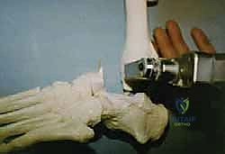 TECH FIG 4 Sawbones model demonstrating preparation of the arthrodesis site