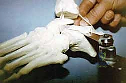 TECH FIG 4 Sawbones model demonstrating preparation of the arthrodesis site