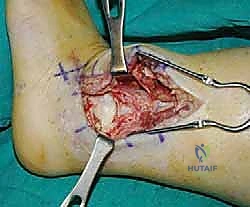 TECH FIG 8 Lateral approach to ankle and subtalar joint after distal fibular resection