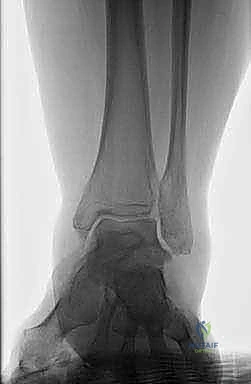 TECH FIG 8 Lateral approach to ankle and subtalar joint after distal fibular resection