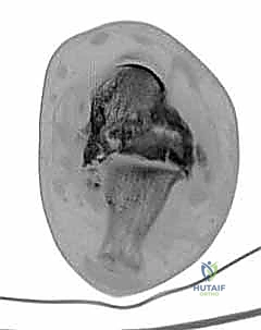 TECH FIG 8 Lateral approach to ankle and subtalar joint after distal fibular resection
