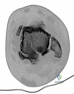 TECH FIG 8 Lateral approach to ankle and subtalar joint after distal fibular resection