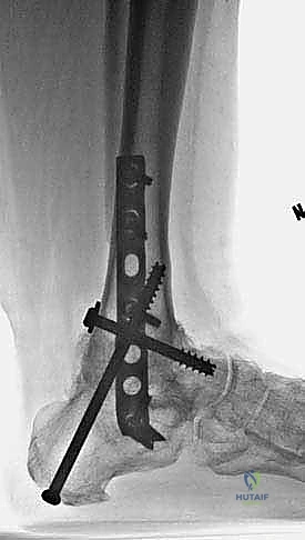 TECH FIG 12 Final follow-up radiographs 3 years after procedure