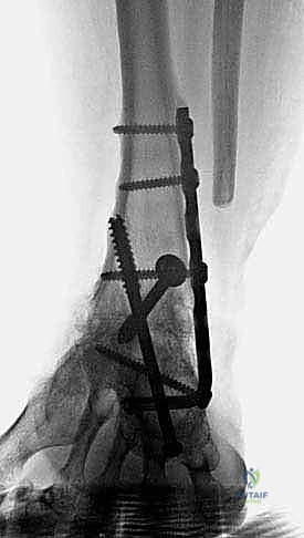 TECH FIG 12 Final follow-up radiographs 3 years after procedure