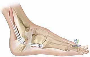 Intraoperative Surgical Step