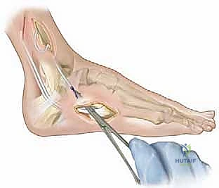 تقييم التوازن الحركي أثناء الجراحة