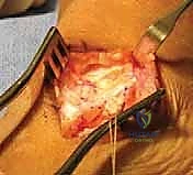 التخطيط الجراحي الدقيق للقدم الحنفاء