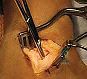 مضاعفات تشوه القدم الحنفاء