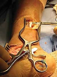 خطوات فصل وتر الظنبوب الخلفي جراحياً