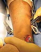 Illustration of tibialis posterior tendon - Dr. Mohammed Hutaif