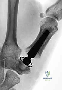 Thumb Carpometacarpal Joint Arthroplasty: An Intraoperative Masterclass in Resurfacing and Total Joint Replacement
