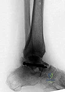 التحضير لعملية تثبيت مفصل الكاحل