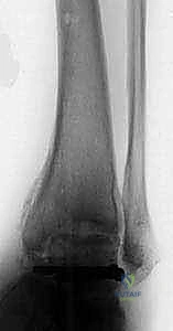 خطوات جراحة دمج مفصل الكاحل والقدم