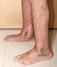 صورة توضيحية لـ تثبيت مفصل الكاحل والقدم (Tibial-Calcaneal Arthrodesis): حل جذري لفقدان عظم الكاحل والعدوى