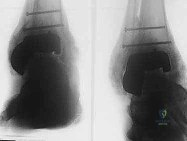 تأكيد التثبيت والدمج العظمي