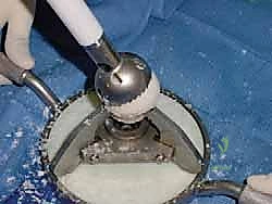 صورة توضيحية لـ دمج مفصل الكاحل والقدم الخلفية باستخدام الطعم العظمي من رأس عظم الفخذ حلول معقدة على يد الأستاذ الدكتور محمد هطيف