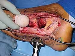 التشريح الأساسي لمفصل الكاحل والقدم الخلفية