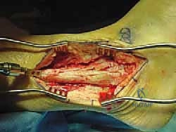 صورة توضيحية لـ دمج مفصل الكاحل والقدم الخلفية باستخدام الطعم العظمي من رأس عظم الفخذ حلول معقدة على يد الأستاذ الدكتور محمد هطيف