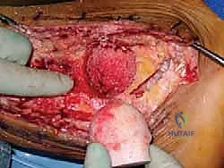 صورة توضيحية لـ دمج مفصل الكاحل والقدم الخلفية باستخدام الطعم العظمي من رأس عظم الفخذ حلول معقدة على يد الأستاذ الدكتور محمد هطيف