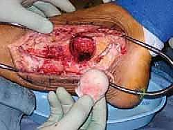 صورة توضيحية لـ دمج مفصل الكاحل والقدم الخلفية باستخدام الطعم العظمي من رأس عظم الفخذ حلول معقدة على يد الأستاذ الدكتور محمد هطيف