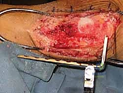 صورة توضيحية لـ دمج مفصل الكاحل والقدم الخلفية باستخدام الطعم العظمي من رأس عظم الفخذ حلول معقدة على يد الأستاذ الدكتور محمد هطيف