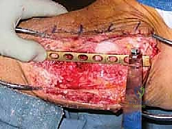 تنظيف المفصل وإزالة العظام الميتة