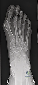 تصحيح إبهام القدم الأروح اليافع جراحة ميشيل دليل شامل للمرضى بخبرة الأستاذ الدكتور محمد هطيف