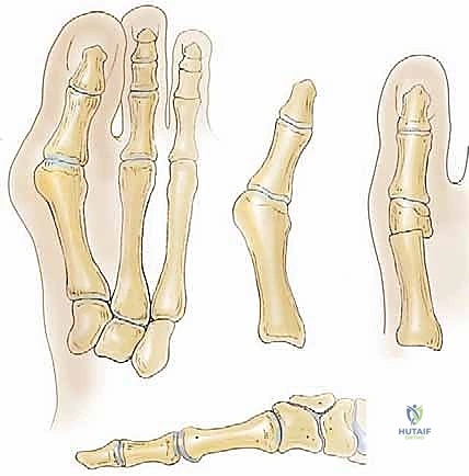 الأشعة السينية لتشخيص إبهام القدم الأروح اليافع