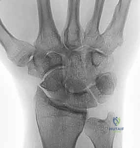 استئصال الزائدة الإبرية الكعبرية: دليل شامل لعلاج خشونة الرسغ المفتوح مع الأستاذ الدكتور محمد هطيف
